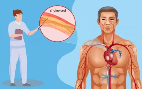 Treatment and Symptoms of High Cholesterol